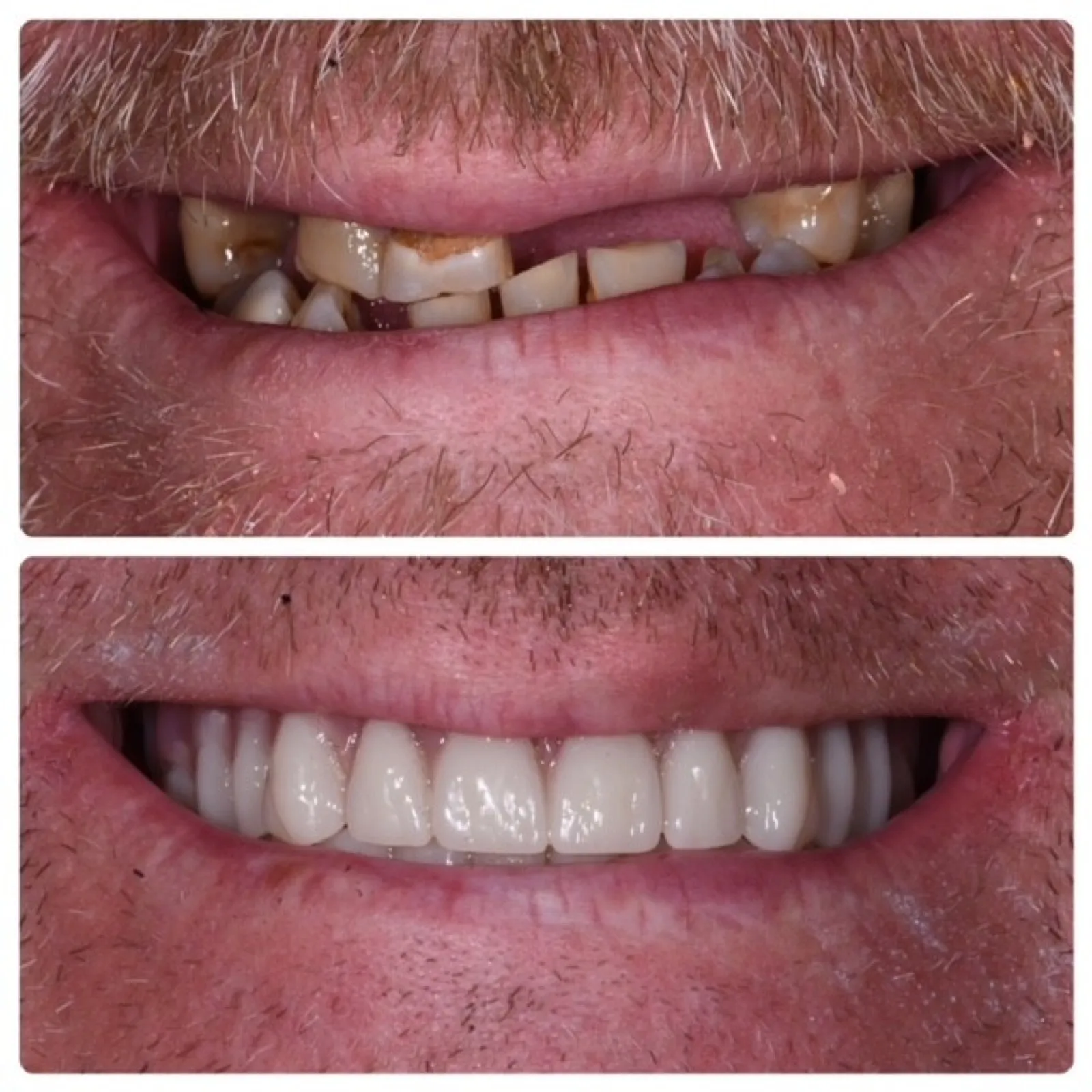 Before and after smile transformation