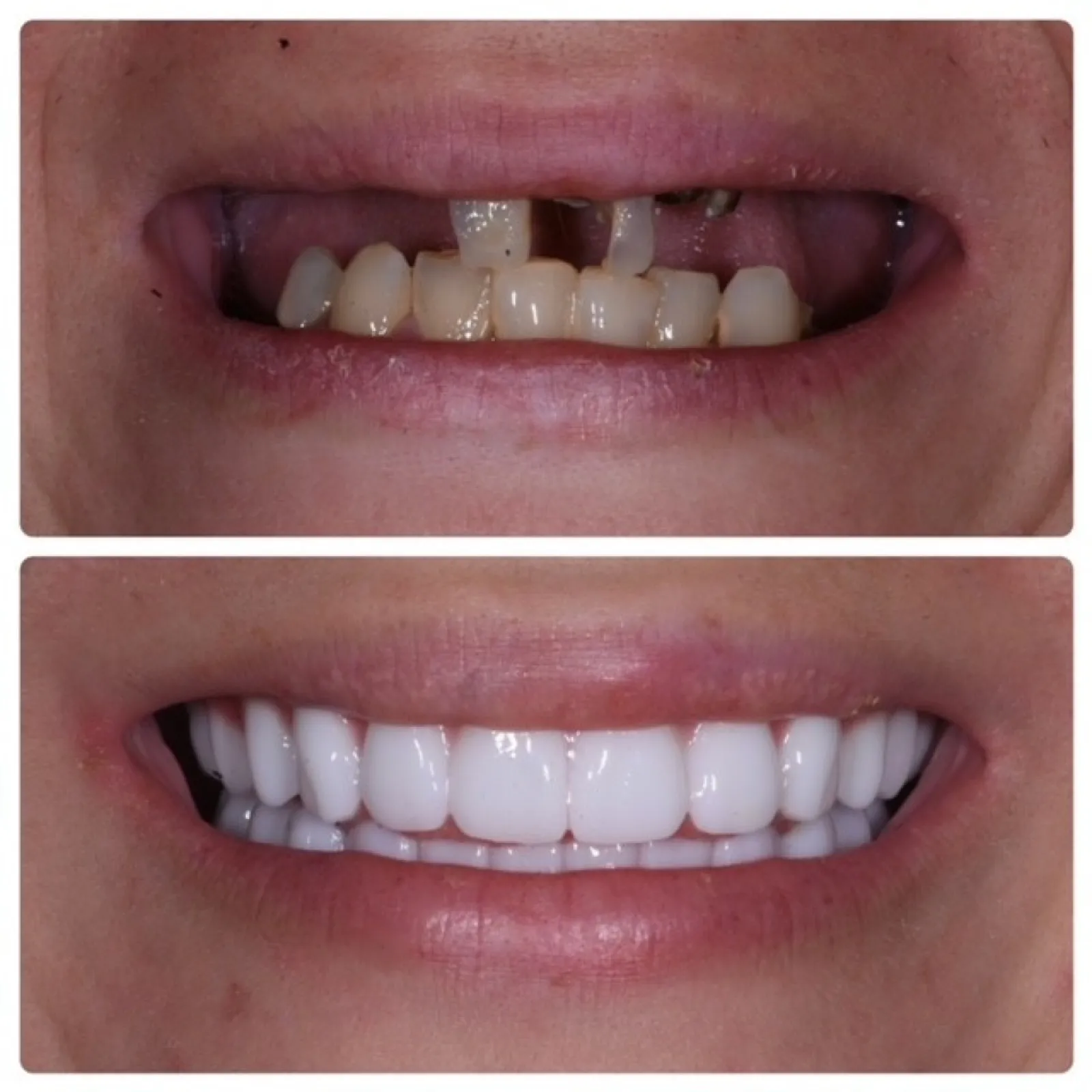 Before and after smile transformation