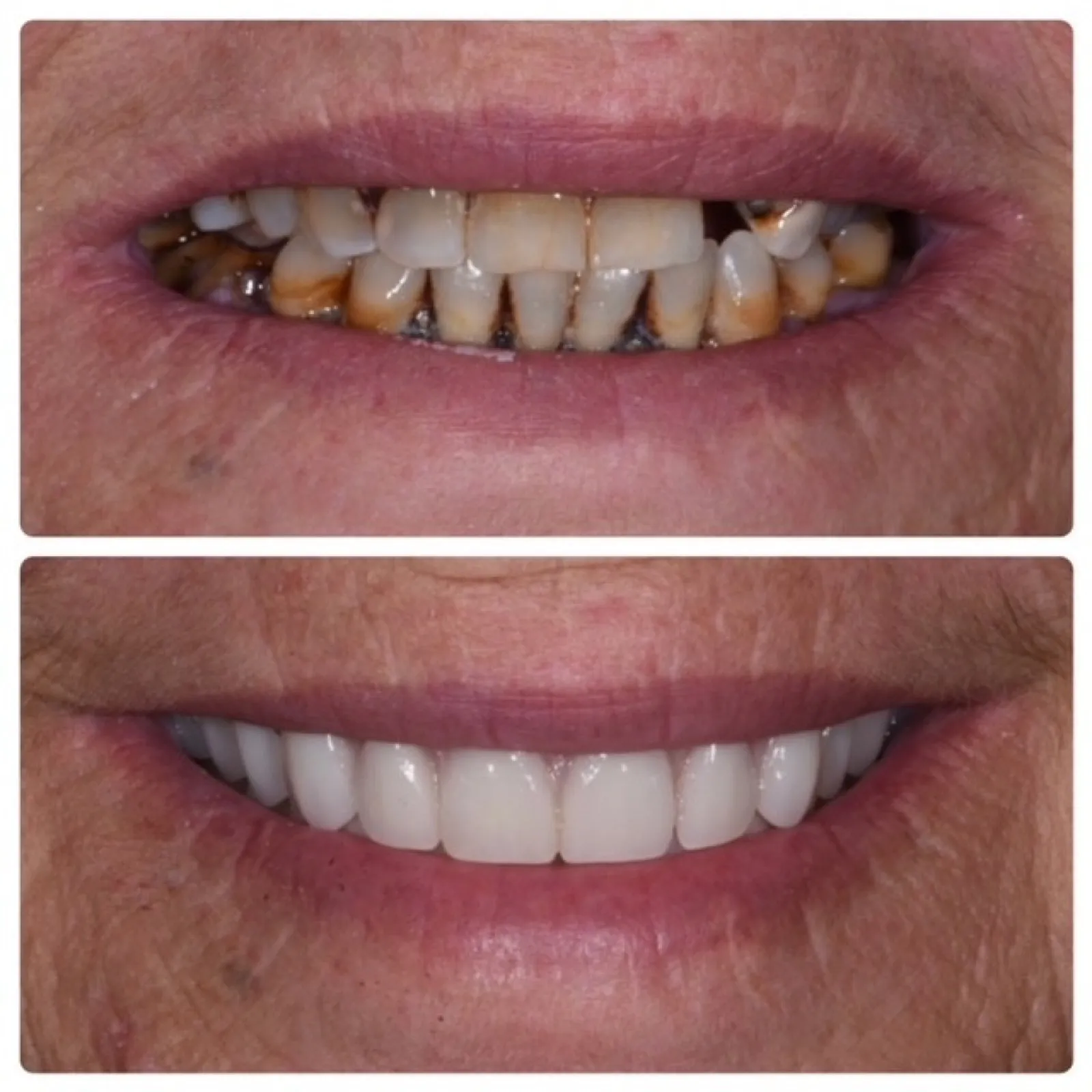 Before and after smile transformation