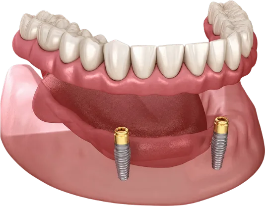 3D illustration of a snap-in denture positioned above two dental implants in the jaw